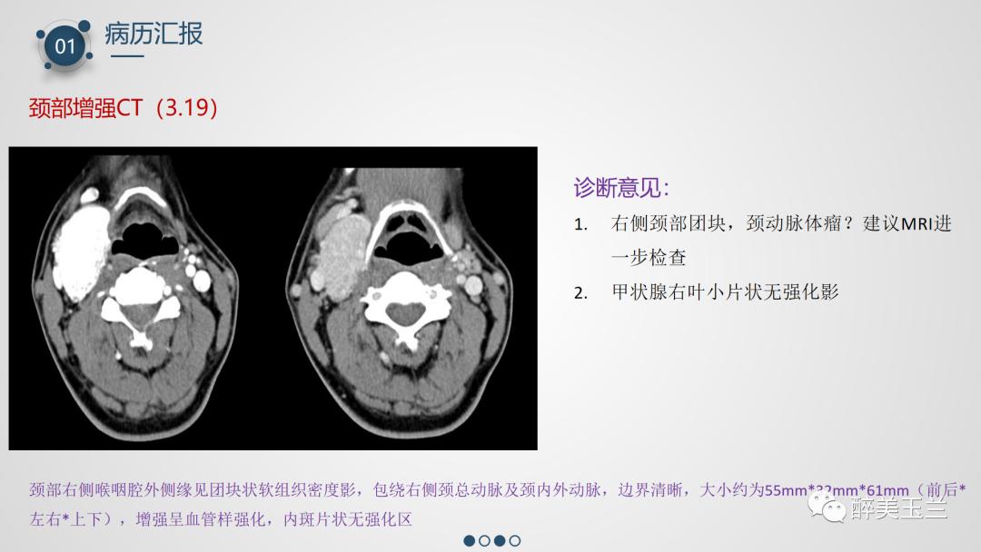 颈动脉体瘤切除术患者的麻醉管理,PPT课件