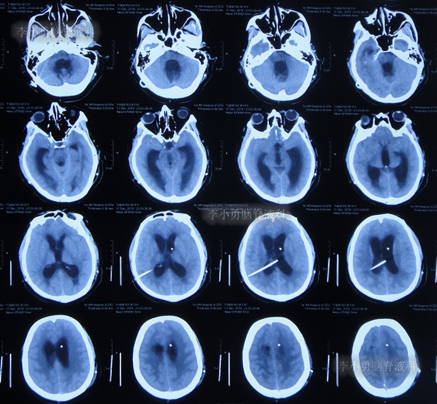脑积水三脑室造瘘多久能恢复,脑囊虫手术后脑积水