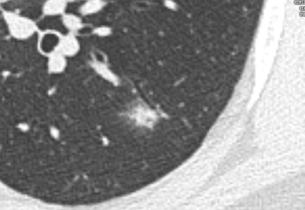 肺结节进一步检查排除肿瘤,肺结节4mm报告建议复查