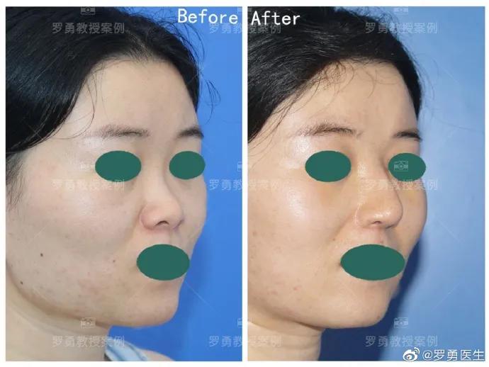 鼻综合鼻头挛缩山根太高怎么修复,鼻综合后山根太低