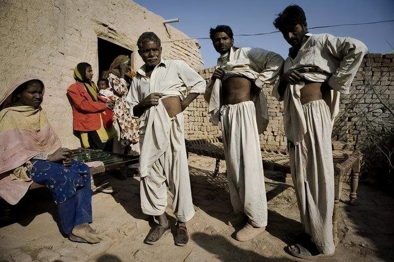 尼泊尔有个单肾村,尼泊尔单肾村的故事