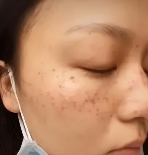 老年色素沉着斑怎么消除,色素沉着老年斑能去除吗