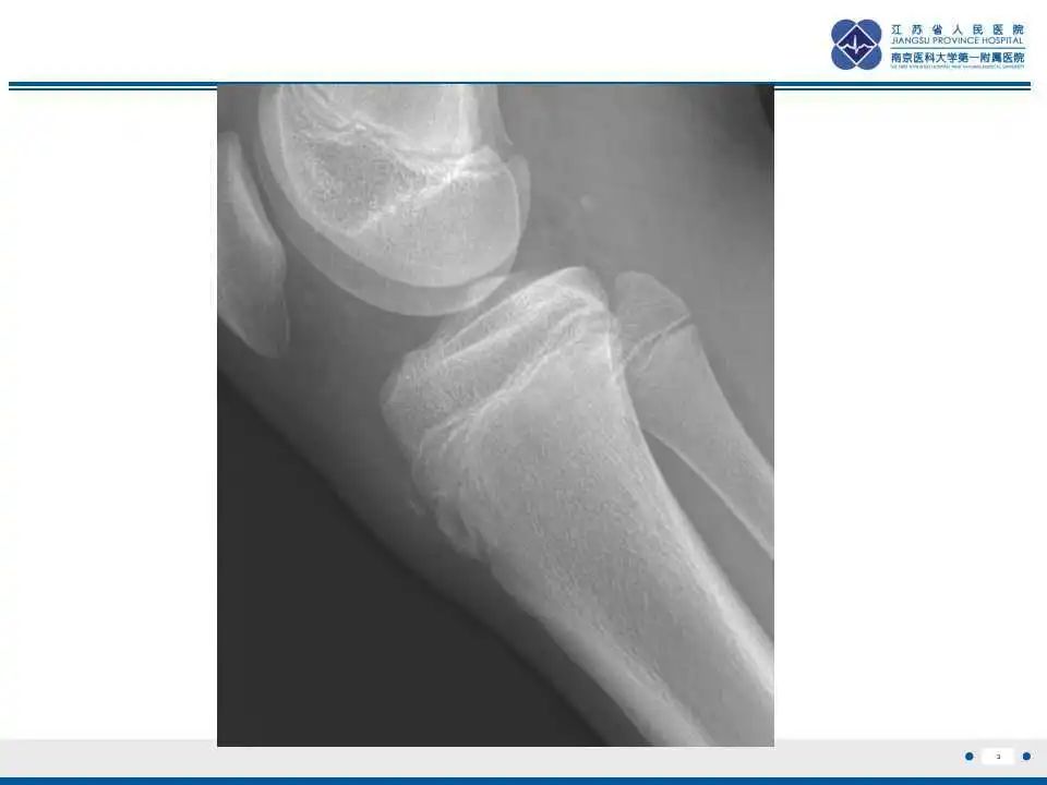 胫骨结节软骨炎要怎么治疗,胫骨结节骨软骨炎会癌变吗