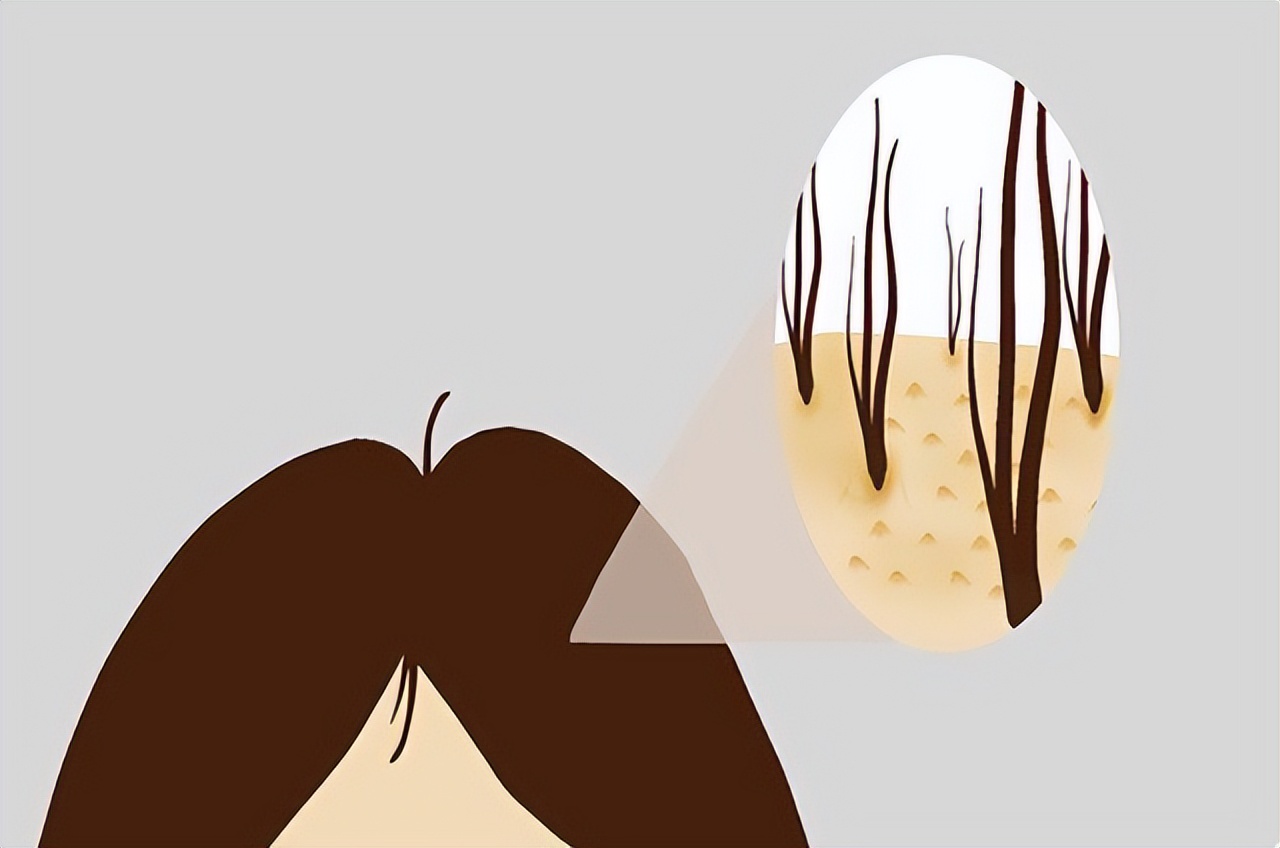 头皮长疙瘩和脓包的常见原因,头皮总是长疙瘩或脓包是什么原因