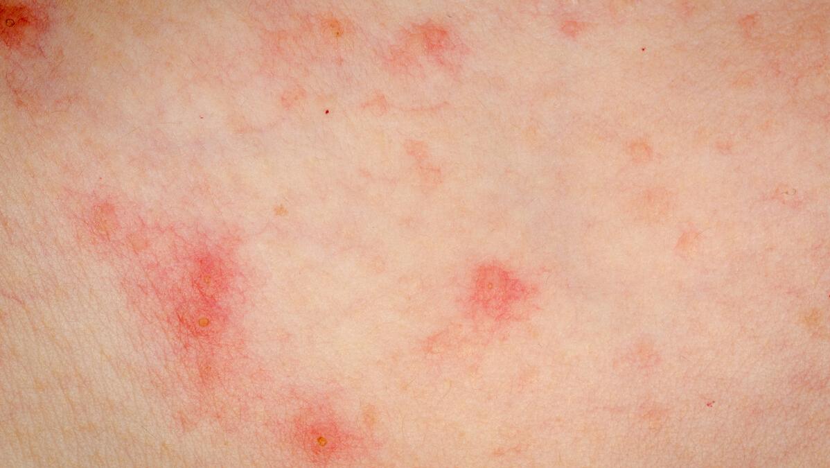 湿疹痱子傻傻分不清,湿疹和痱子我们应该怎么区分