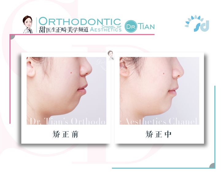 不拔牙矫正嘴凸下巴后缩案例,嘴瘪不拔牙矫正嘴会凸怎么办