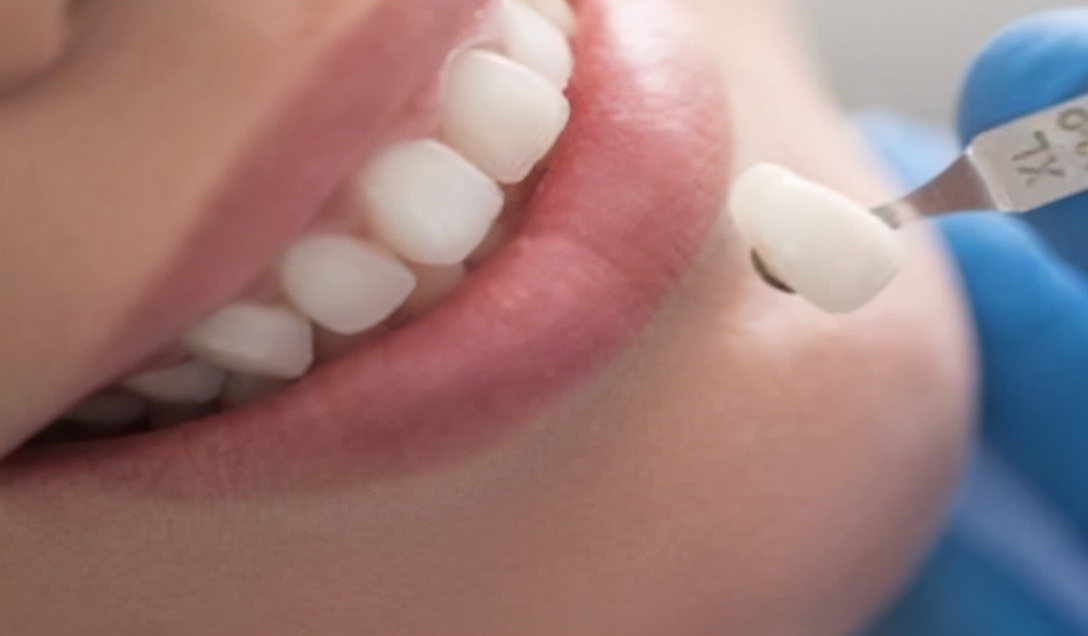 种牙假牙是不是暴利,假牙暴利一颗牙1280成本是多少