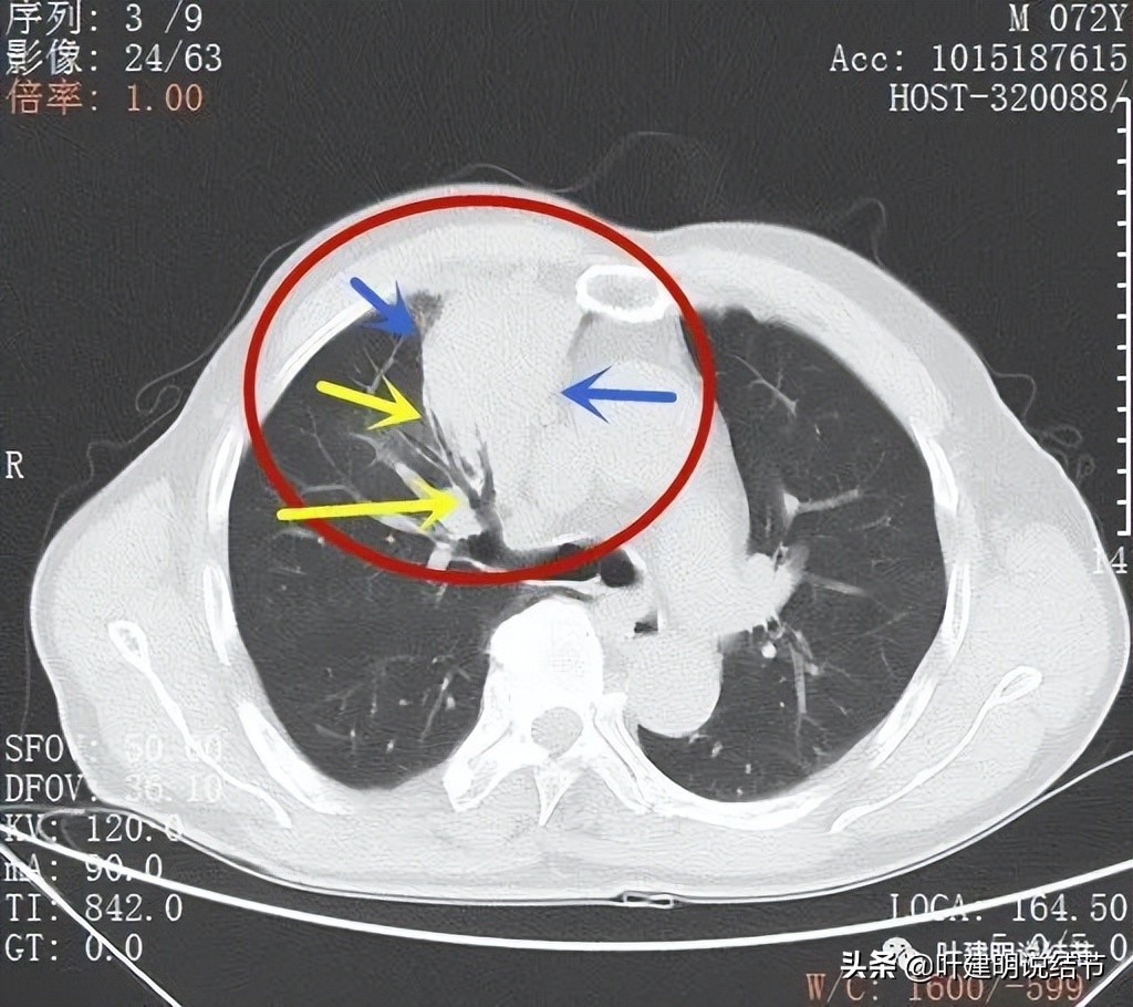 经验：肺占位超6厘米，不是癌还会是什么？临床上仍得多个心眼