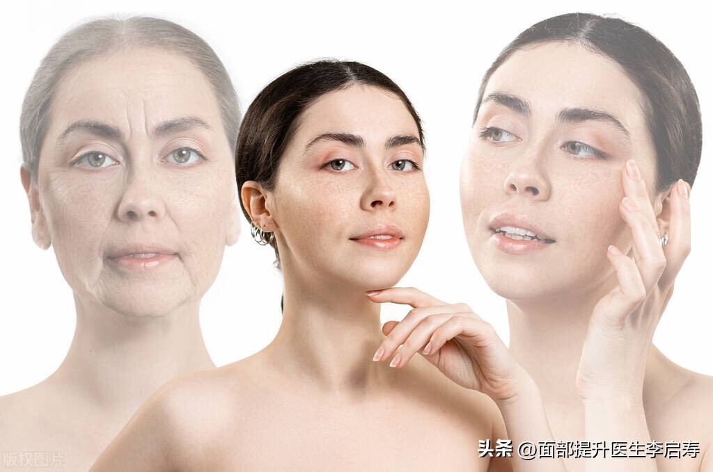 面部筋膜提升多久才是最佳效果,面部筋膜提升术5年后加速衰老