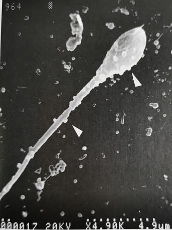 uu感染会自愈么,uu感染是hiv吗