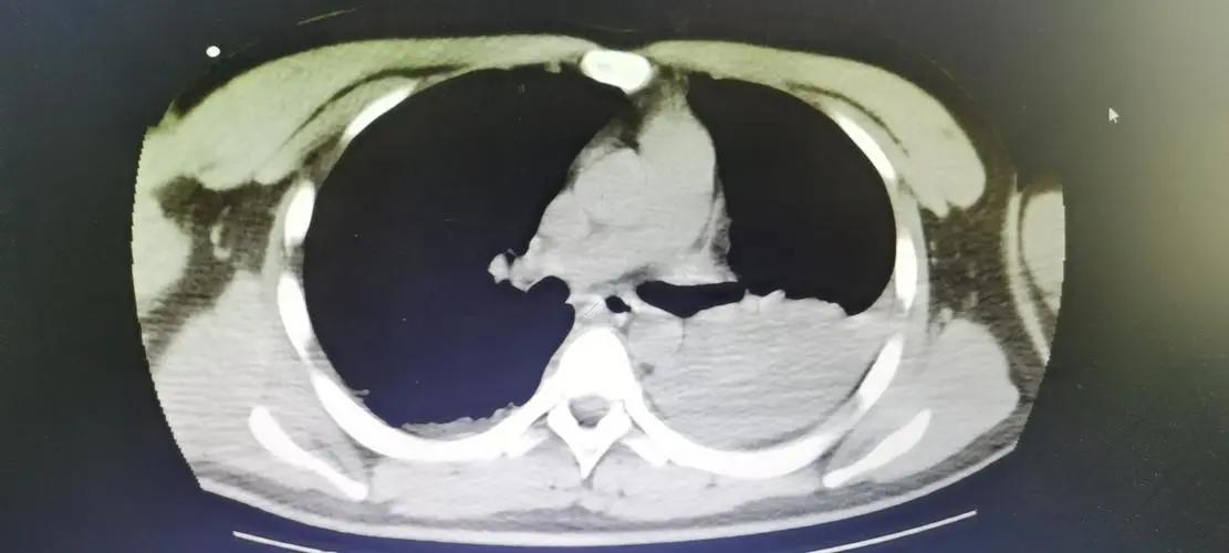 骨盆后环损伤后，新型螺钉的不同内固方法各有何优势？哪种方法好