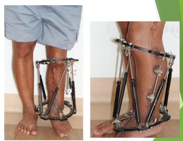 先天性马蹄足,先天性马蹄足矫形方法