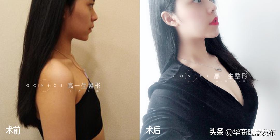 高医生隆胸后续,隆胸手术18天成果展示