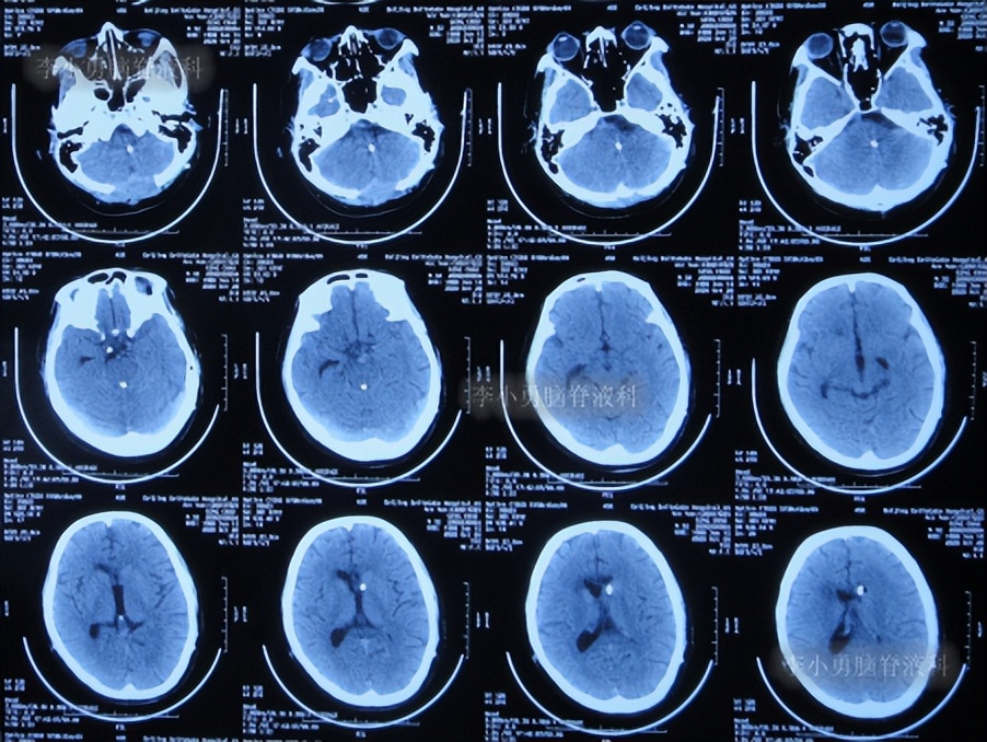 脑积水三脑室造瘘多久能恢复,脑囊虫手术后脑积水