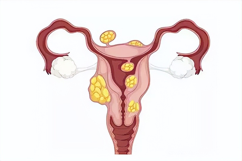 查出子宫肌瘤，能吃西瓜吗？医生：不想肌瘤增大，这5物尽量少吃