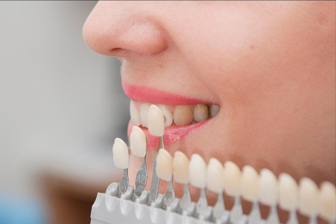 牙齿贴面什么材质经济又耐用,牙齿瓷贴面哪家做的好