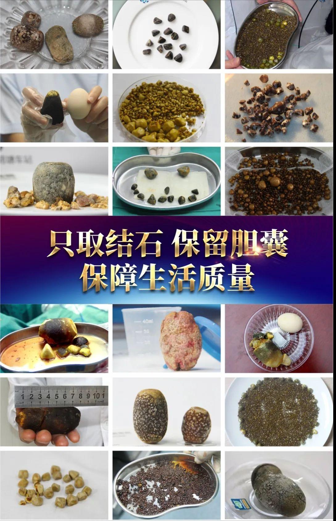 胆结石指南2022,胆结石诊疗指南最新版