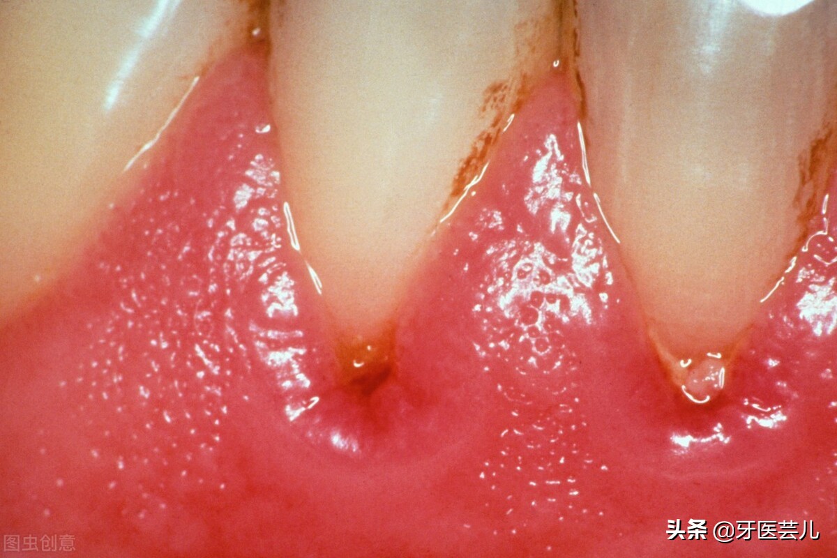 牙龈被牙医磨了一直出血,牙龈出血怎么办有什么好方法吗