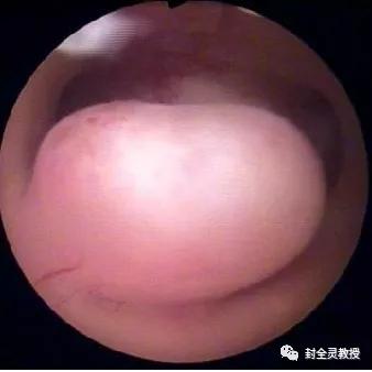 妇科专家教你认识宫腔镜,宫腔镜妇科主任