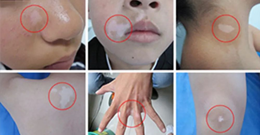 皮肤白斑是麻风吗,白癜风能治好吗白斑能自愈吗