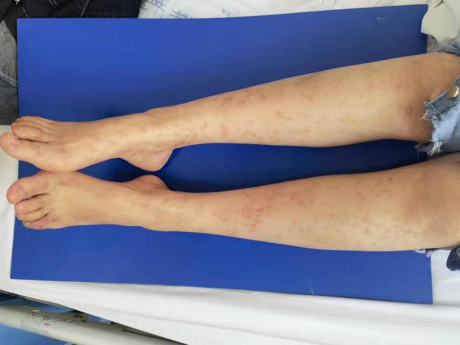 腿上起了湿疹又莫名的发青,女30岁腿脚老是肿怎么回事