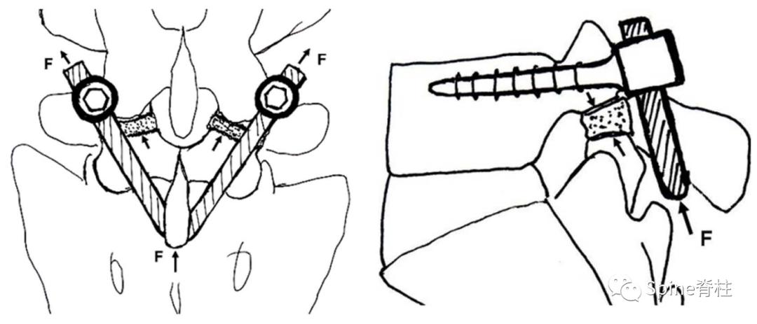 轻度峡部裂和重度峡部裂的区别,真性峡部裂和假性峡部裂