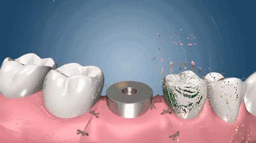 种植牙一颗多少元大概,种植牙究竟多少钱一颗