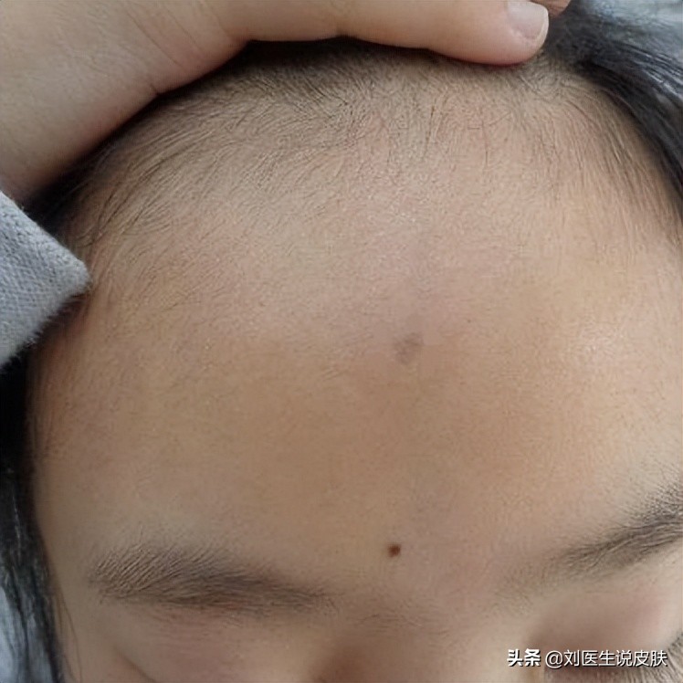 晕痣型白癜风初期和中期的区别,黑痣型白癜风怎么治