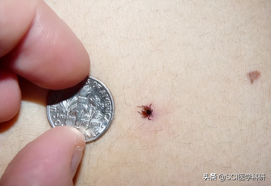 男子户外踏青被蜱虫叮咬高烧不止,男子被蜱虫叮咬住进icu
