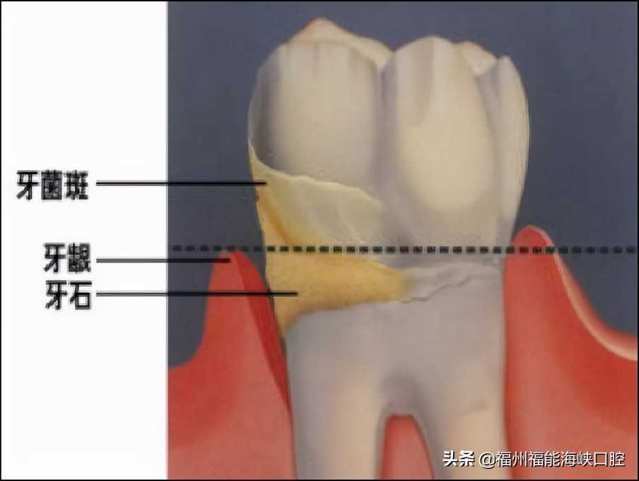 牙齿不整齐导致牙结石过多,牙结石导致牙齿松动洗牙后会好吗