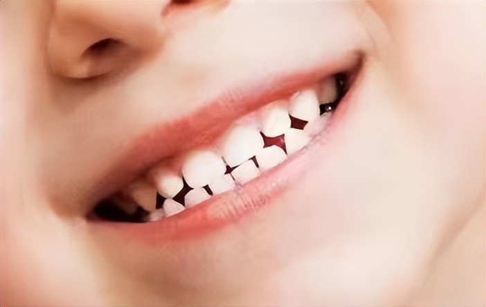 宝宝牙缝大是吃糖引起的吗,宝宝牙缝太宽了吧