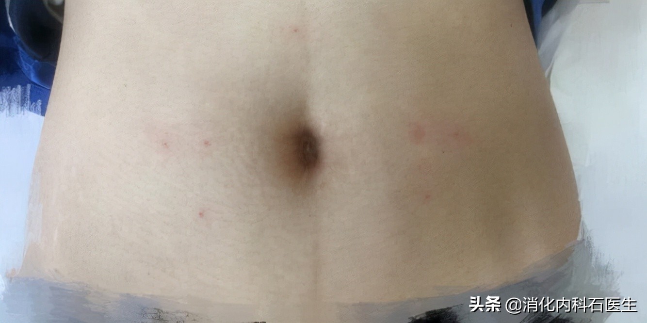 人流时出现子宫穿孔,大出血流产女子肚子疼