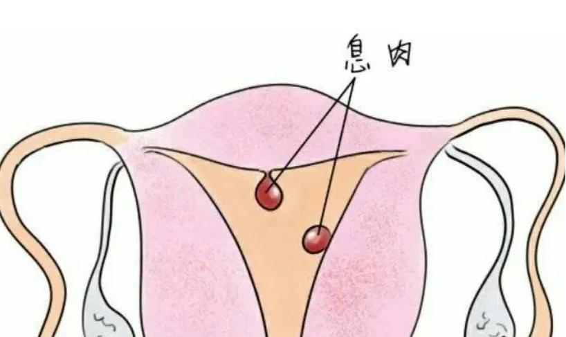 防止内膜息肉复发需要上曼月环吗,内膜息肉怎么防止复发备孕
