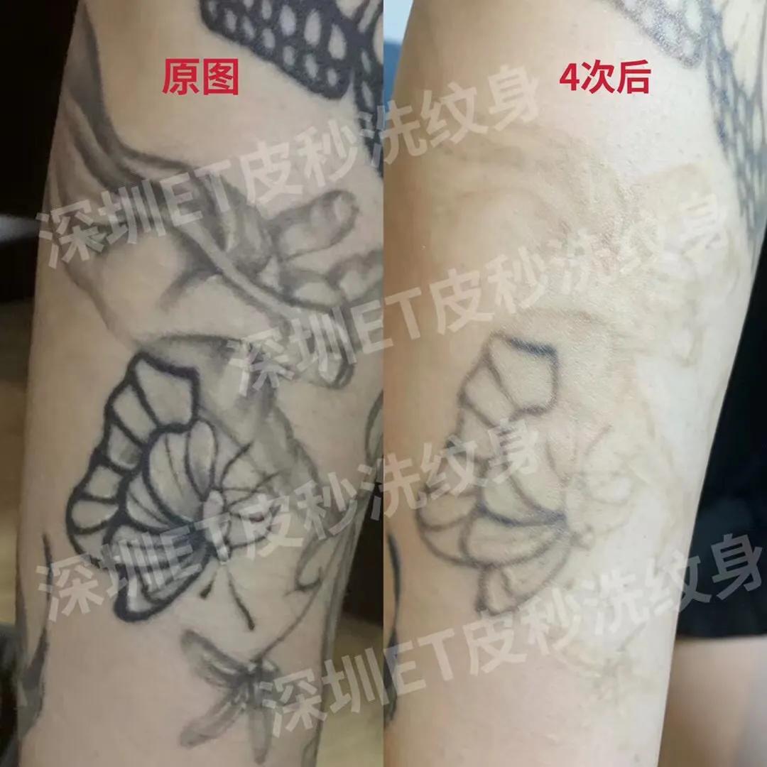 深圳清洗纹身哪家专业,推荐深圳专业洗纹身