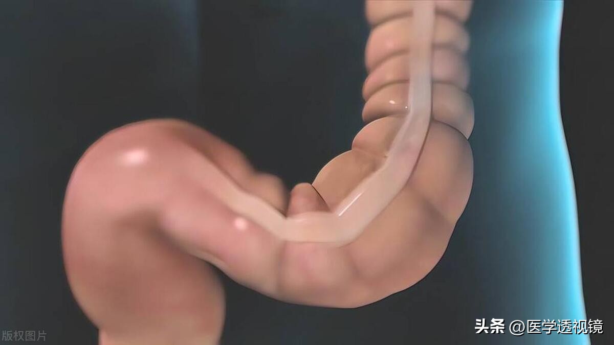 治疗溃疡性结肠炎脓血便有啥办法,溃疡性结肠炎粘液脓血便