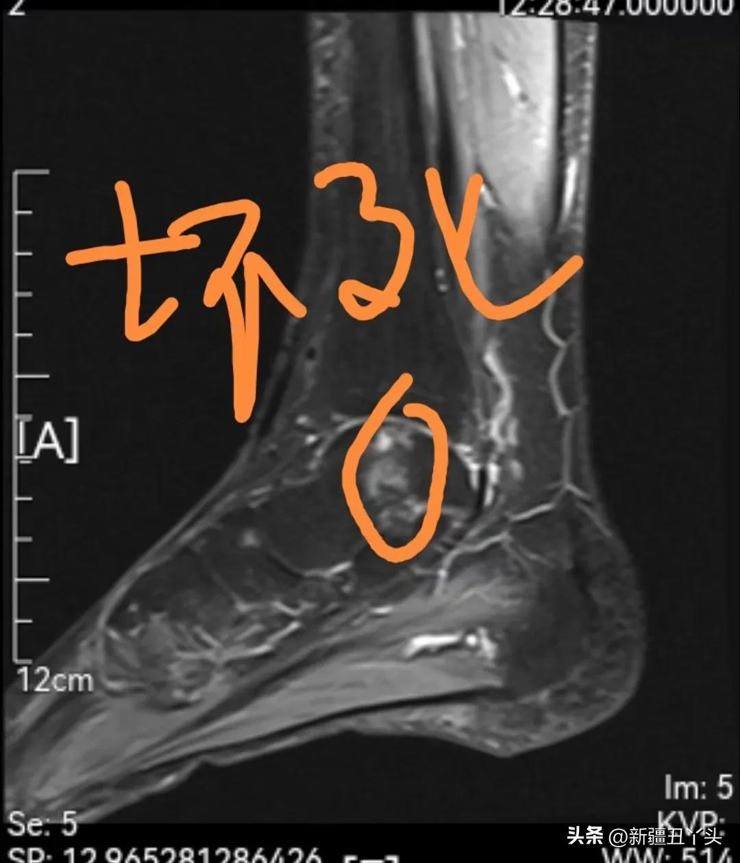 距骨坏死靠敷药能改变不,距骨坏死初期可以正常行走吗