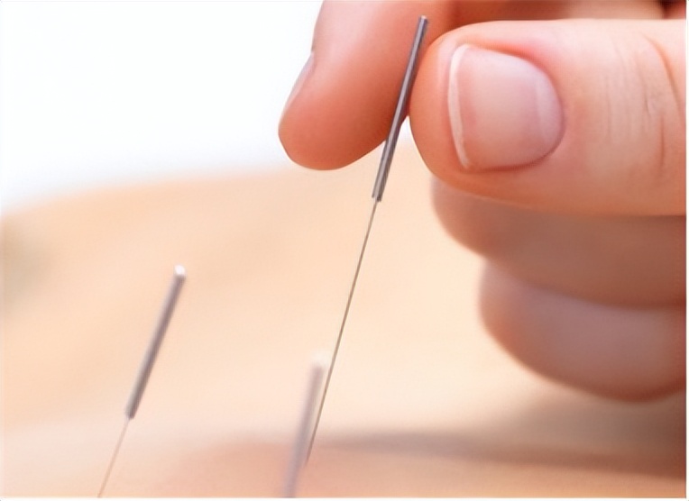 刺络拔罐联合常规针刺治疗神经根型颈椎病如何治疗?疗效如何?