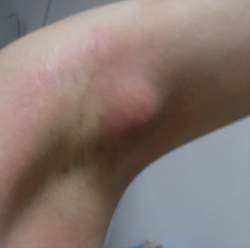腋窝长了硬块是艾滋病吗,腋下有肿块有可能是艾滋病吗