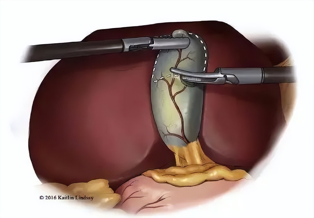 胆囊有罪，真的要杀无赦吗？