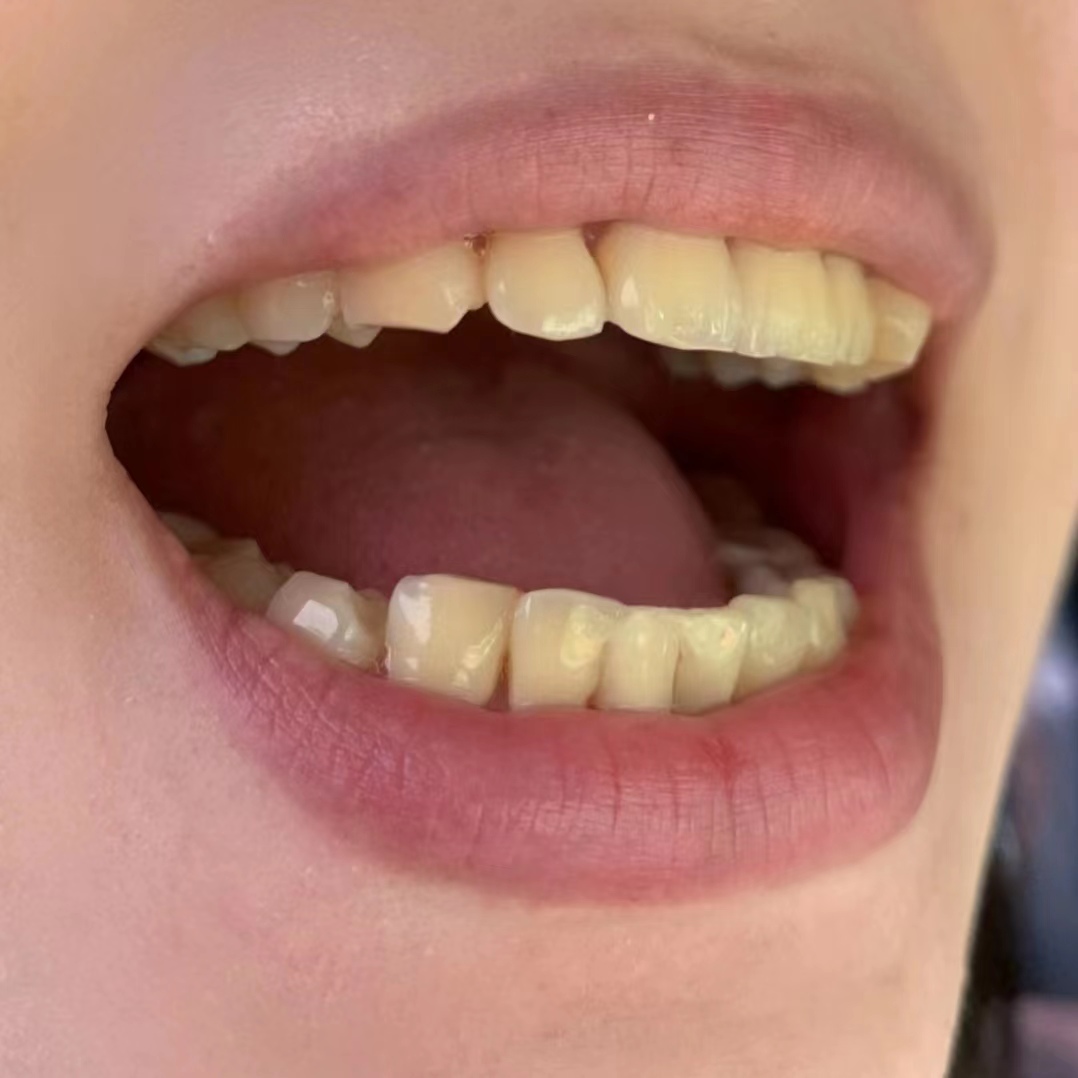 牙黄有好办法吗,牙黄反反复复