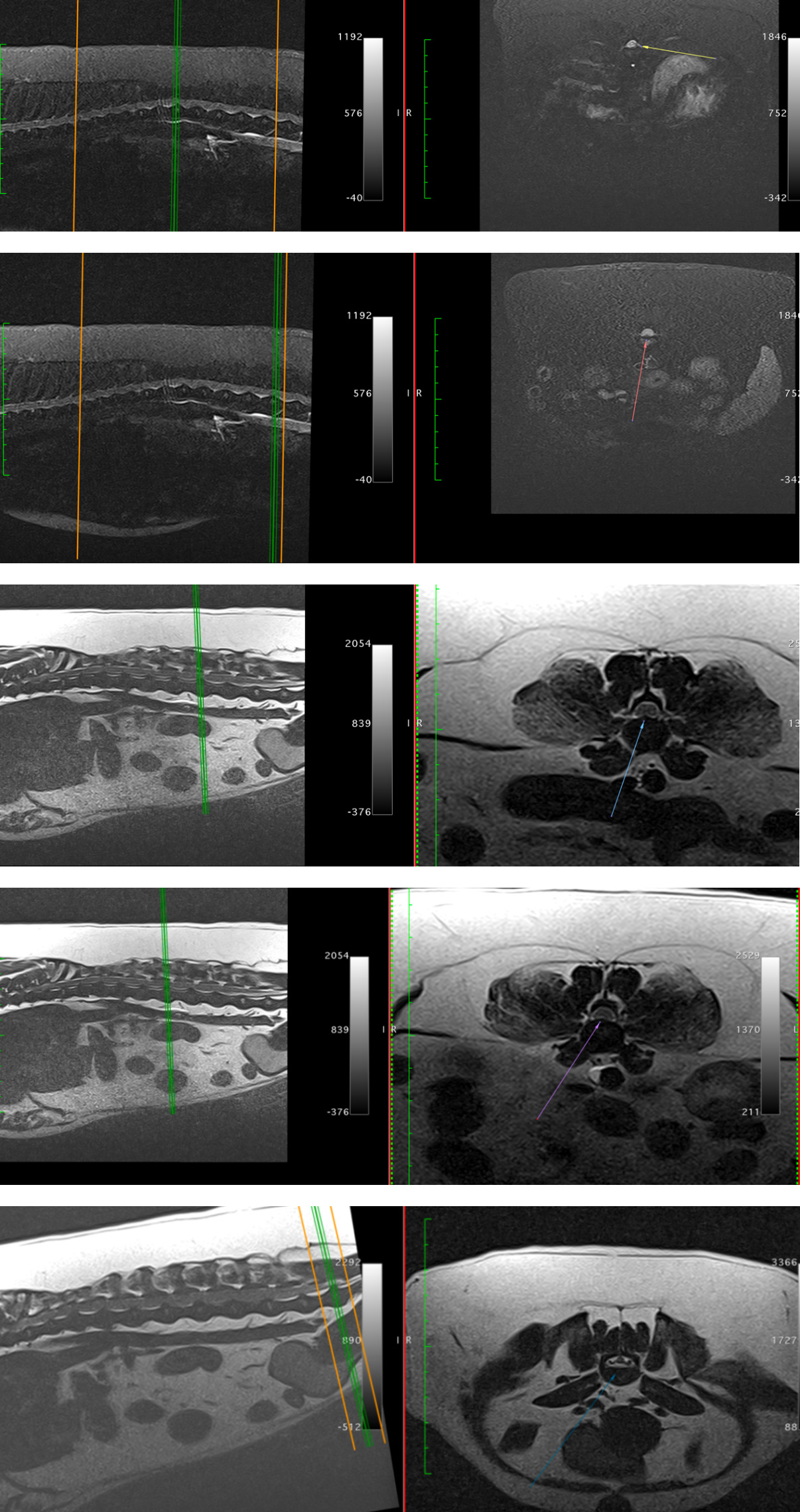射频理疗治疗椎间盘突出,激光治疗腰椎间盘突出的图片