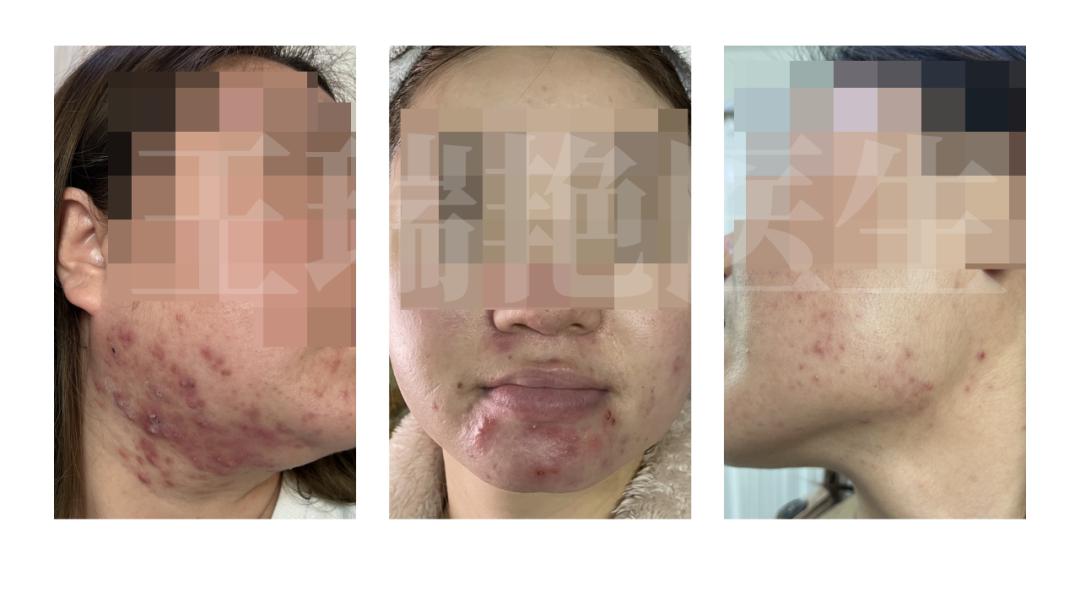 女性脸上长痘痘怎么调理排毒祛痘,祛痘小妙招女性