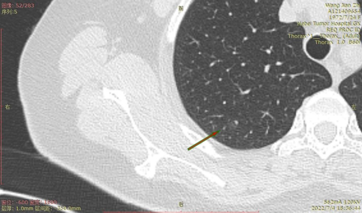 首次发现磨玻璃结节要吃药消炎吗,磨玻璃结节警惕合并占位