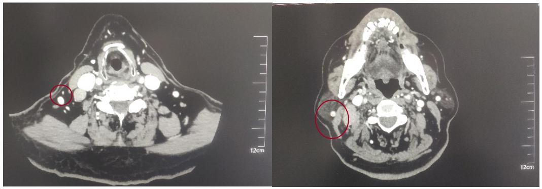 一例Ⅲ期鼻咽癌患者接受同步放化疗联合斯鲁利单抗治疗的经验分享