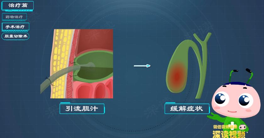 胆囊炎胆结石如何正确治疗,胆囊炎胆结石治疗方案