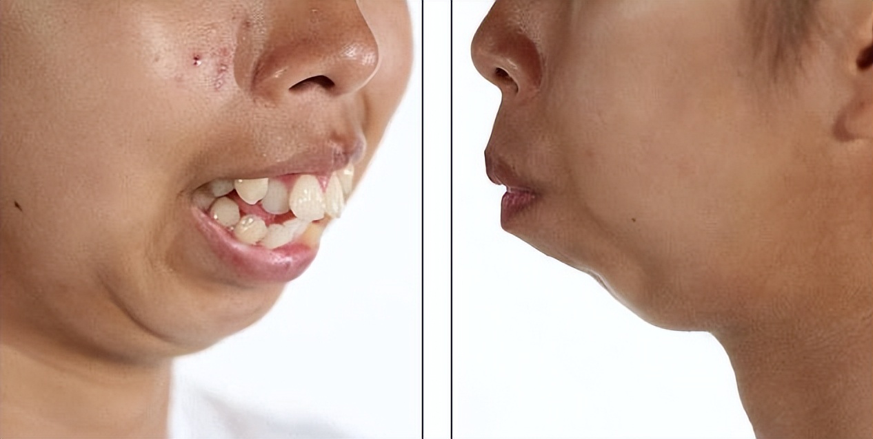 泰国女孩没有下巴,泰国整容最成功的女星