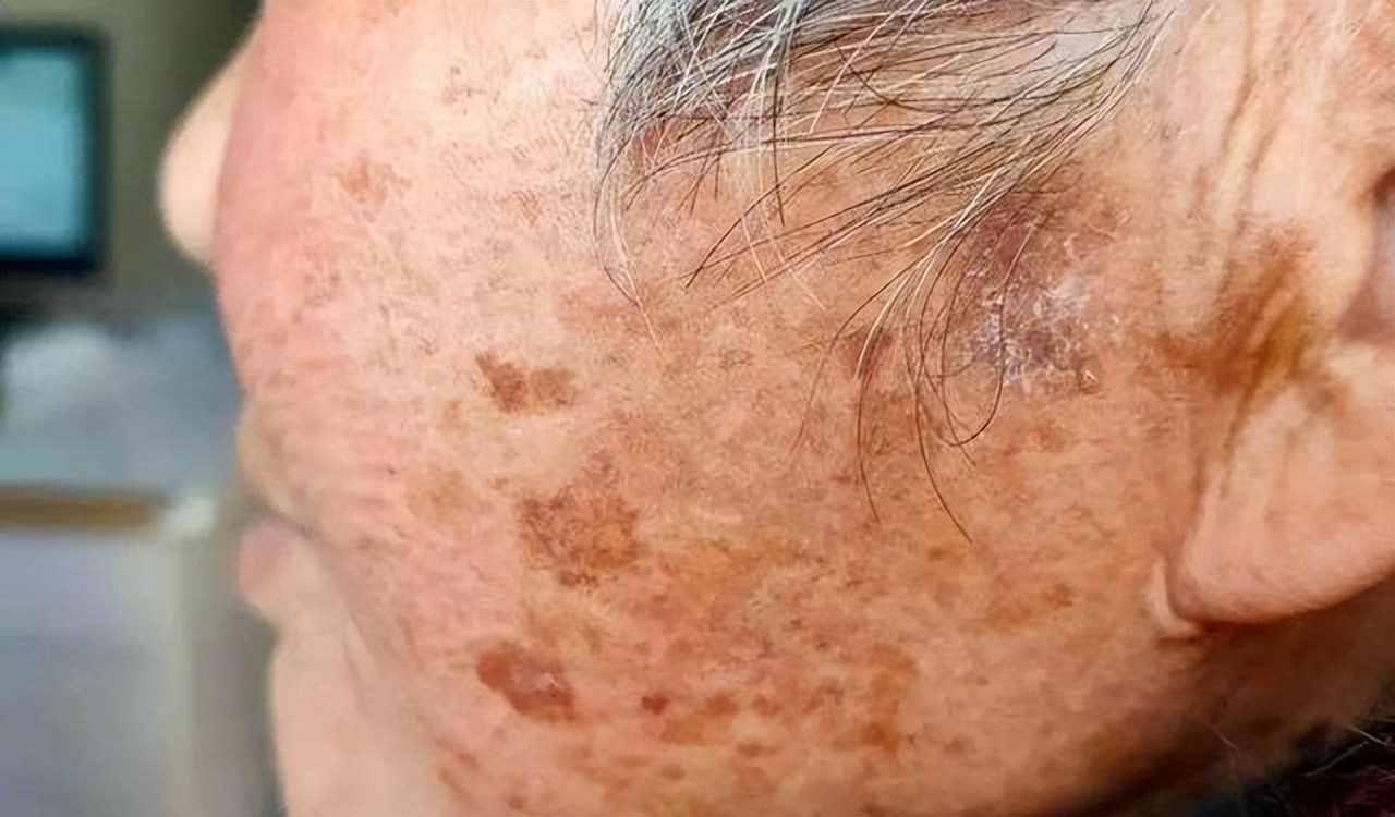 快速消除老年斑的小妙招红霉素,祛老年斑的最佳方法红霉素软膏