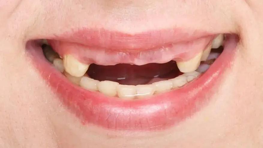 正畸医生为什么不建议植骨,正畸为什么医生不扶正智齿