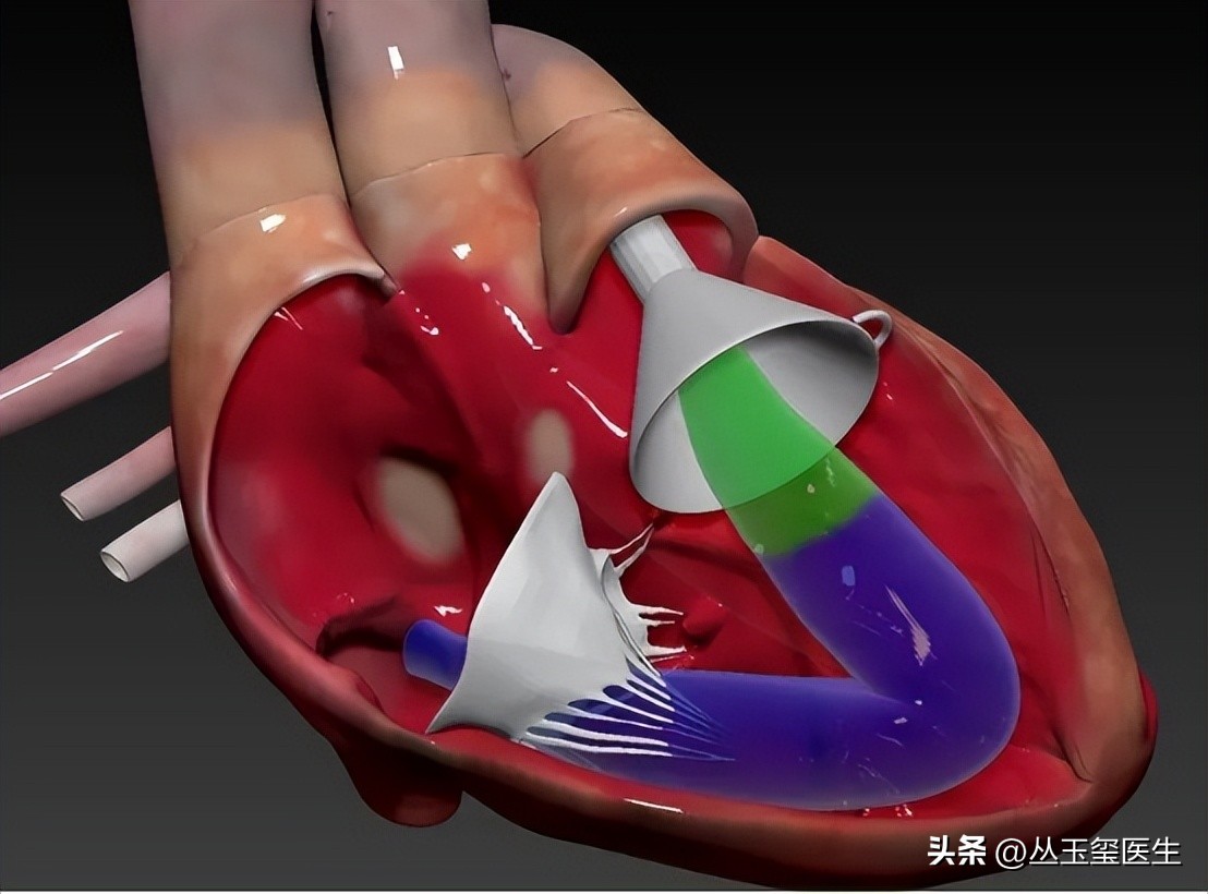 尿毒症死亡主要原因-心血管疾病，超声检查效果如何？