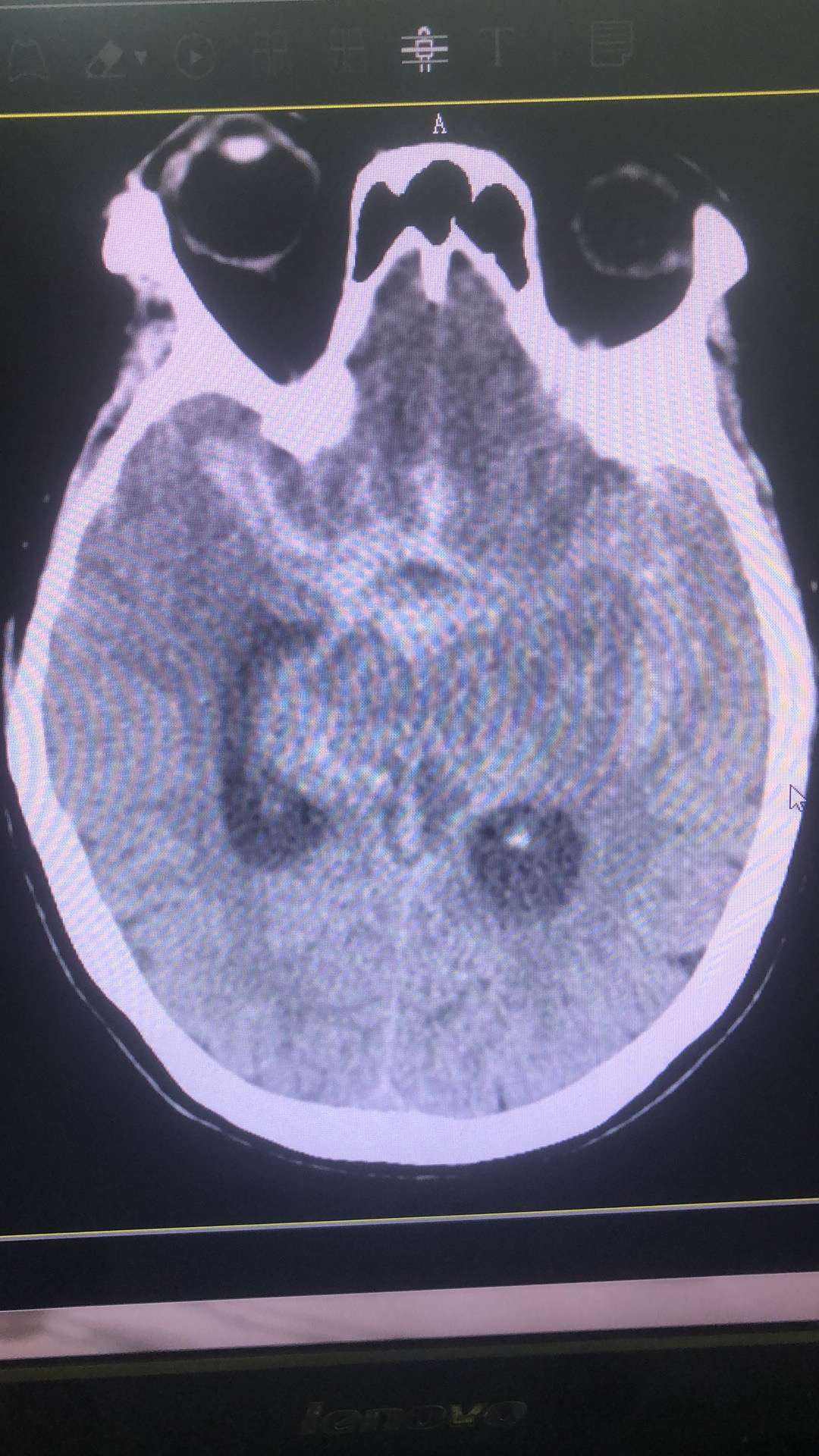 动脉瘤蛛网膜下腔出血术后并发症,动脉瘤导致蛛网膜下腔出血严重吗